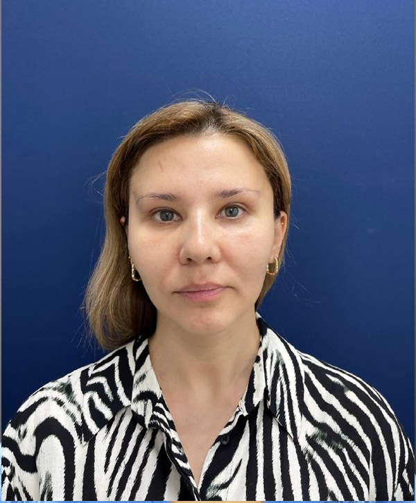 Липофилинг лица и блефаропластика в Симферополе – фото 28